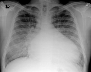 cardiomegalia-edema-pulmonar